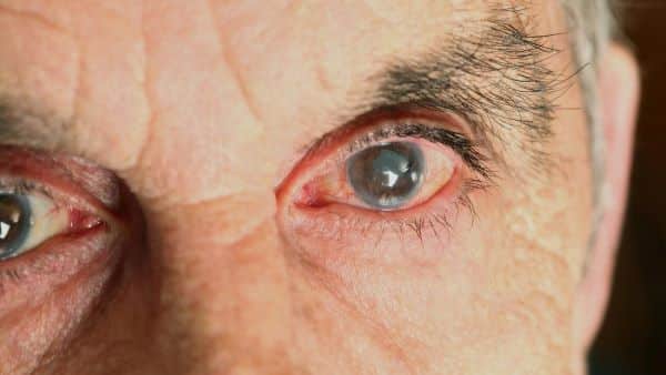 Glaukom, zelený zákal, nemoci očí, vyšetření očí.