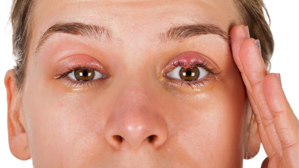 Ječné zrno Hordoleum, nemoci očí, vyšetření očí, měření zraku, celosntí péče o zrak.