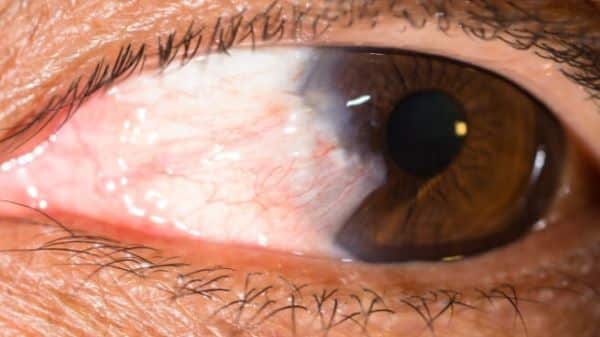 Pterygium a Pinguekula. Nemoci očí, vyšetření očí, celostní péče o zrak.