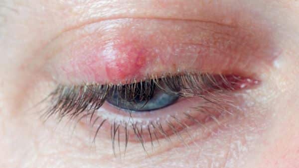 Vlčí zrno (Chalazion), nemoci očí, vyšetření očí, měření zraku, celostní péče o zrak.