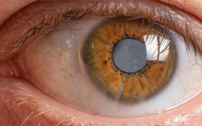 Šedý zákal (Katarakta): Vše co je vhodné vědět o této nemoci očí
