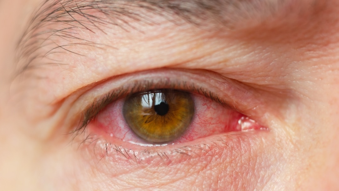 Červené oči a krvavé bělmo: Co nám oči chtějí říct