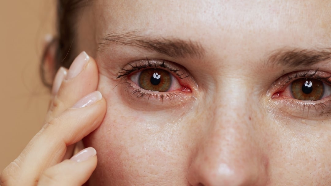 Pálení očí: Co to způsobuje a jak si ulevit